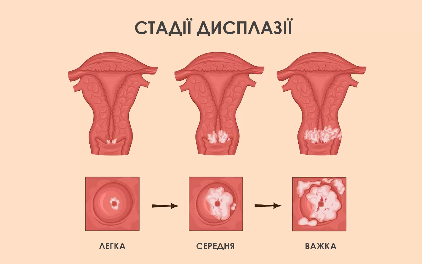 Дисплазія шийки матки має 3 стадії