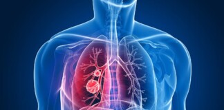 абсцесу легені