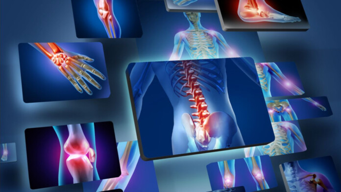 Артроз Артроз