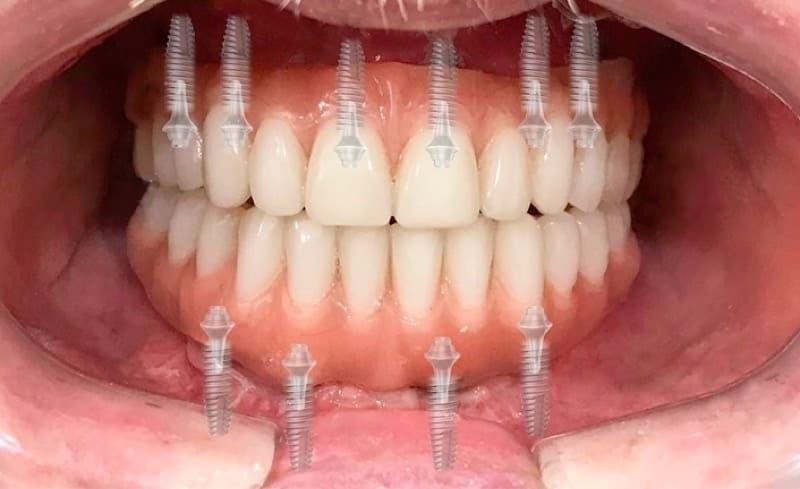 зубний протез