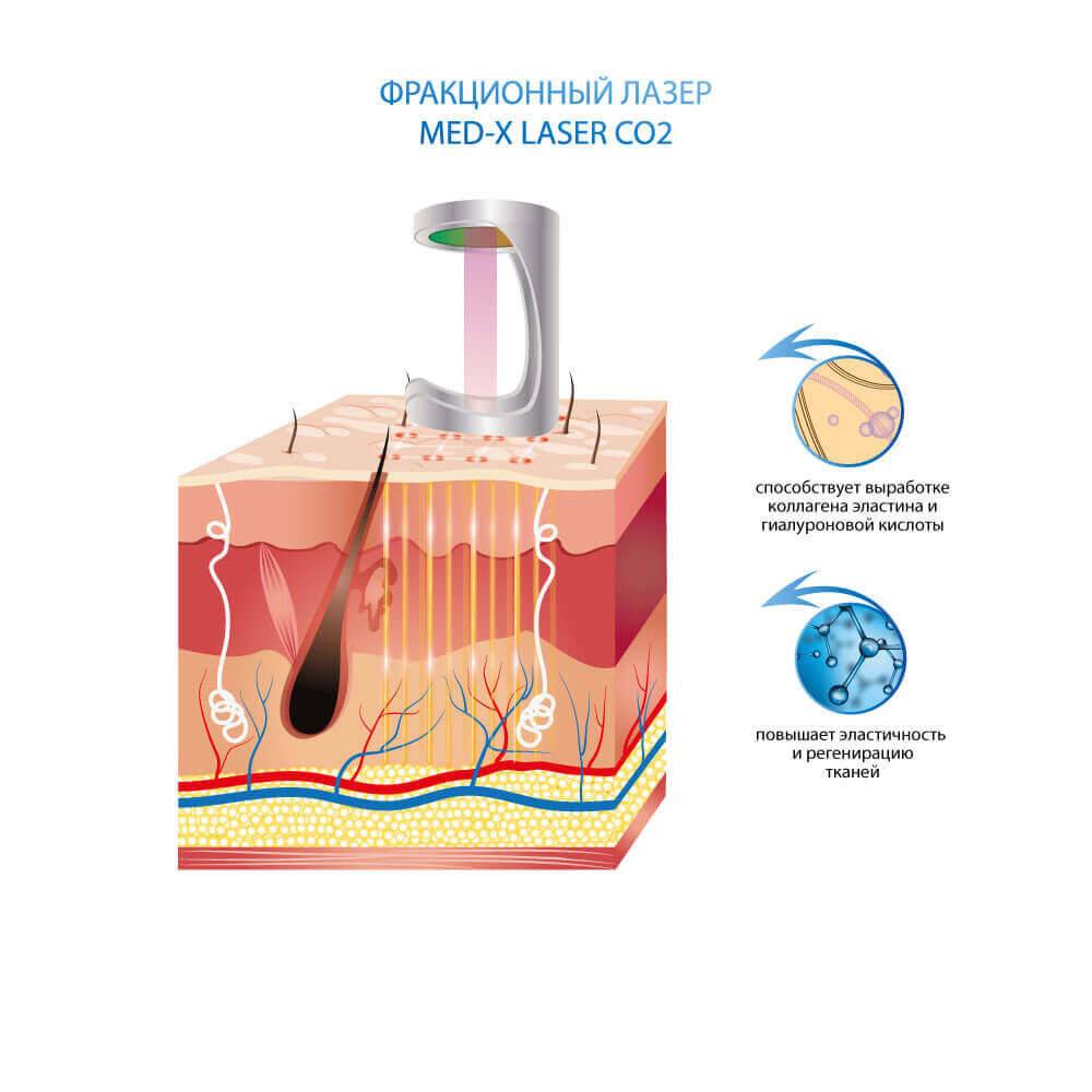 Фракційні лазери