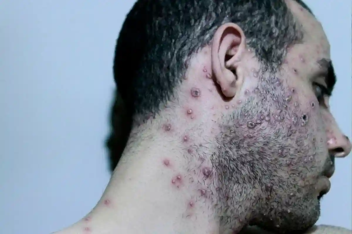 Вірус mpox прийшов до Європи, очікуються нові зараження