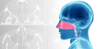 Кіста гайморових пазух