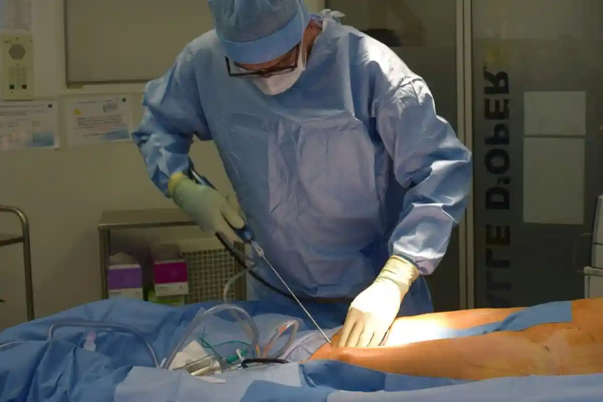 Ліпосакція в Німеччині стане вільною з 2026 року.