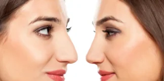 ринопластика