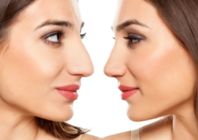 ринопластика