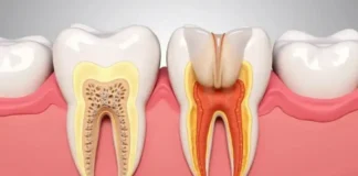 Коли зуб починає нищити корінь: що варто знати про періодонтит зуби